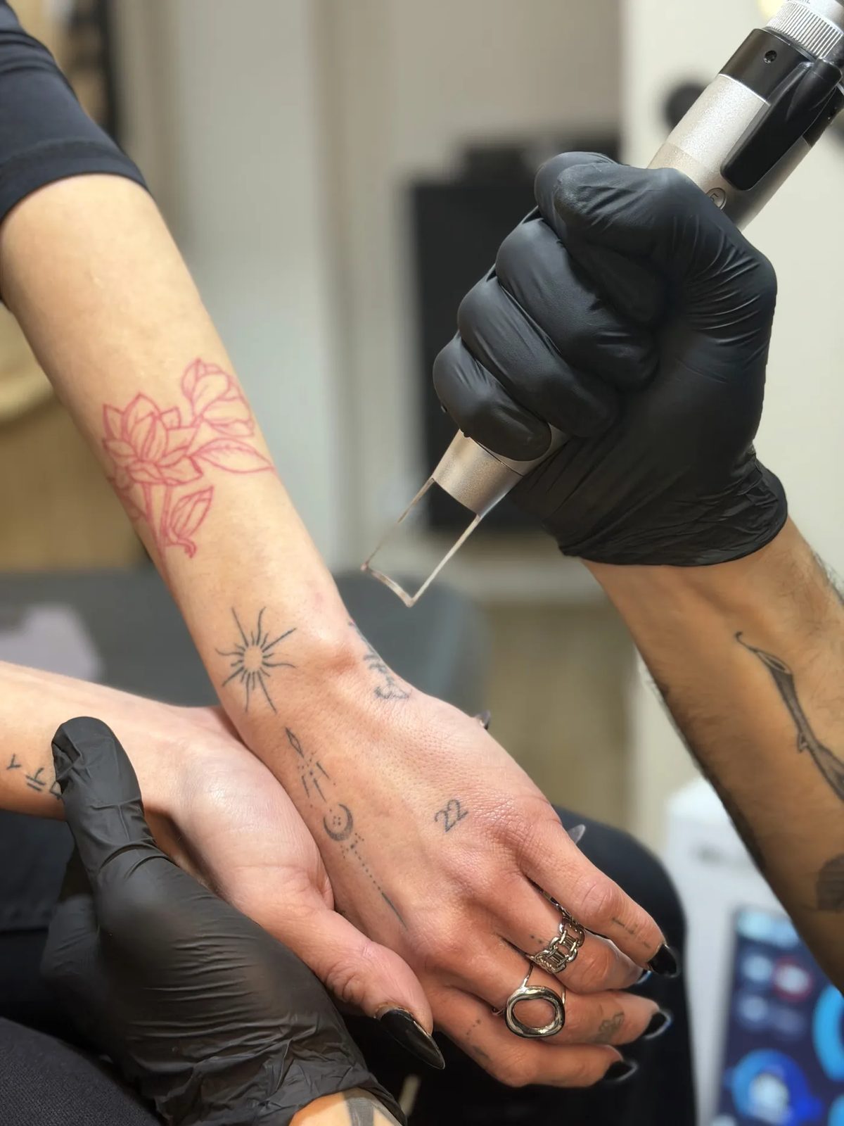 Aclarado láser de un tatuaje antes de hacer un cover-up